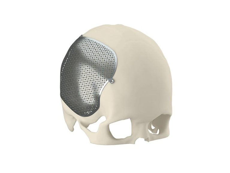 Cranioplasty Solution